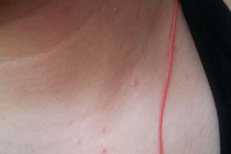 色素性痒疹颈部有红色丘疹图 色素性痒疹颈部有红色丘疹图