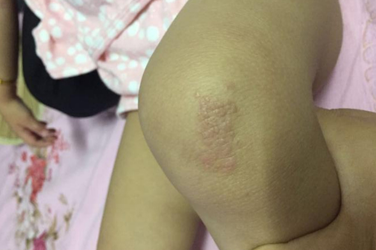 身上长慢性湿疹图