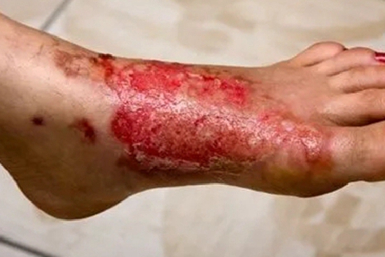 急性淋巴管炎脚背症状图