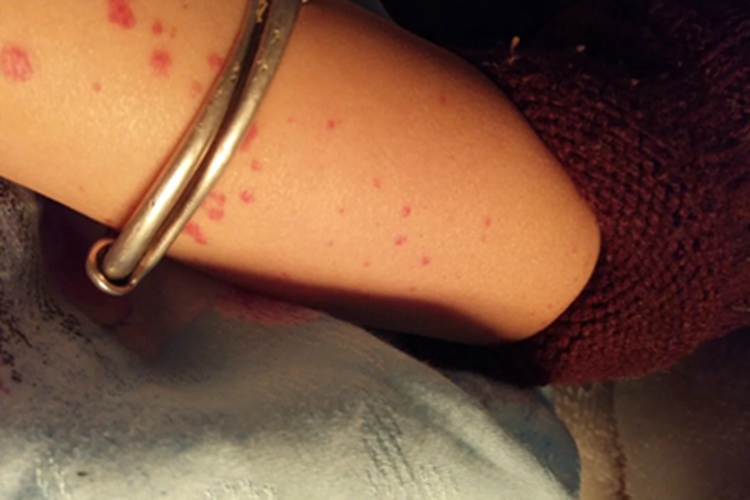 巨球蛋白血症性紫癜胳膊红斑图