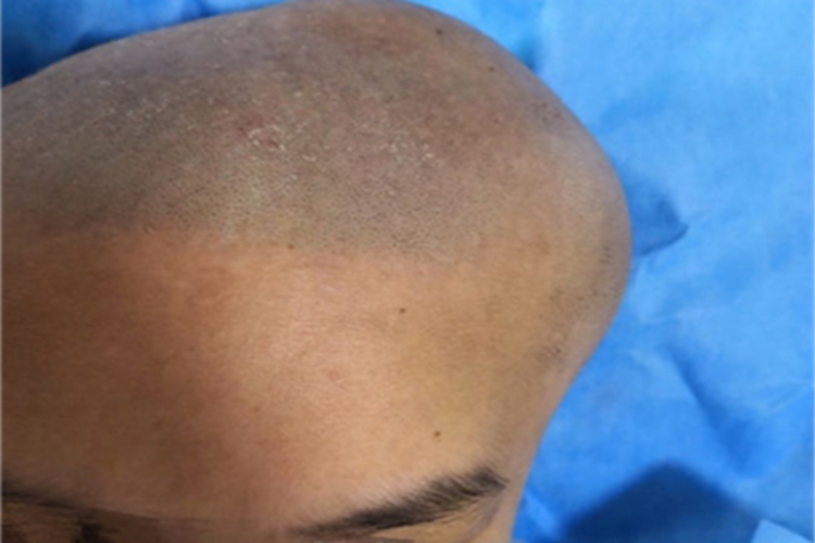 头皮血肿头部软包图 头皮血肿头部软包图