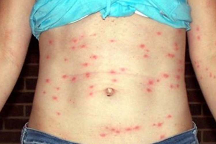 恙螨皮炎腹部小红疙瘩图 恙螨皮炎腹部小红疙瘩图