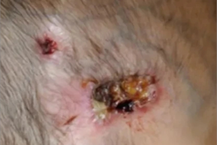 海鱼分枝杆菌感染头皮化脓图 海鱼分枝杆菌感染头皮化脓图