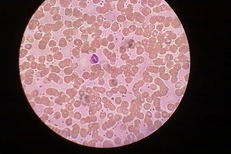 尿红细胞形态图 尿红细胞形态图