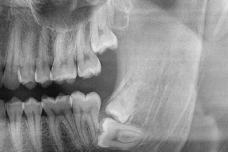 X线牙片图 X线牙片图