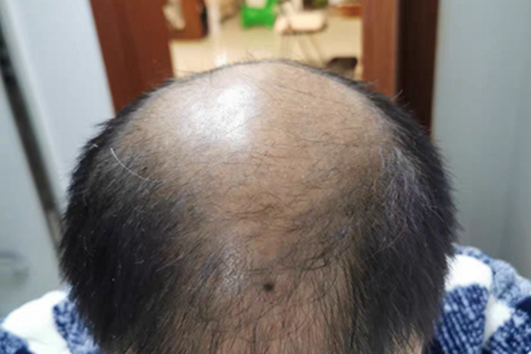 雄激素性脱发头顶光秃秃的图 雄激素性脱发头顶光秃秃的图
