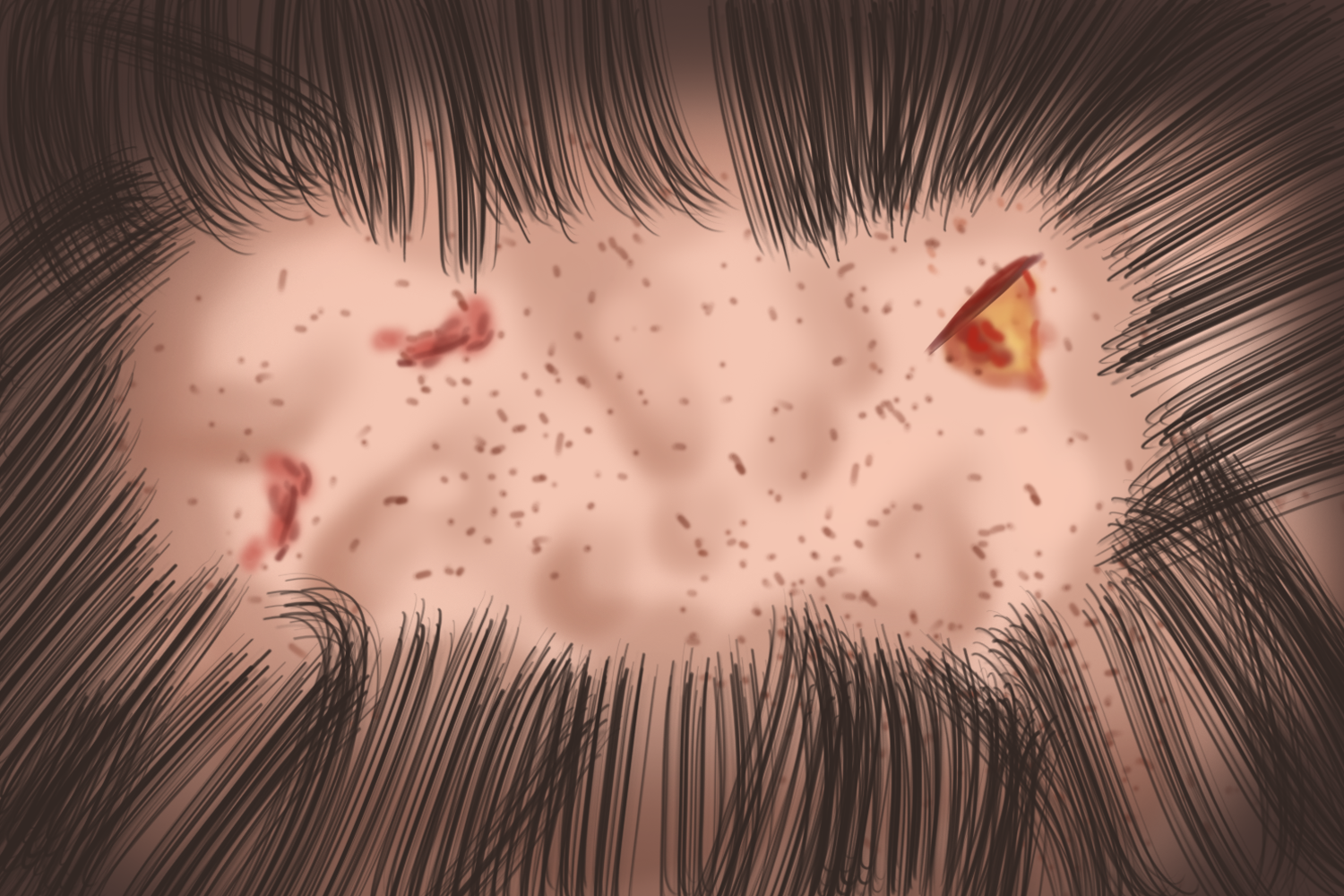 穿掘性毛囊炎切开图