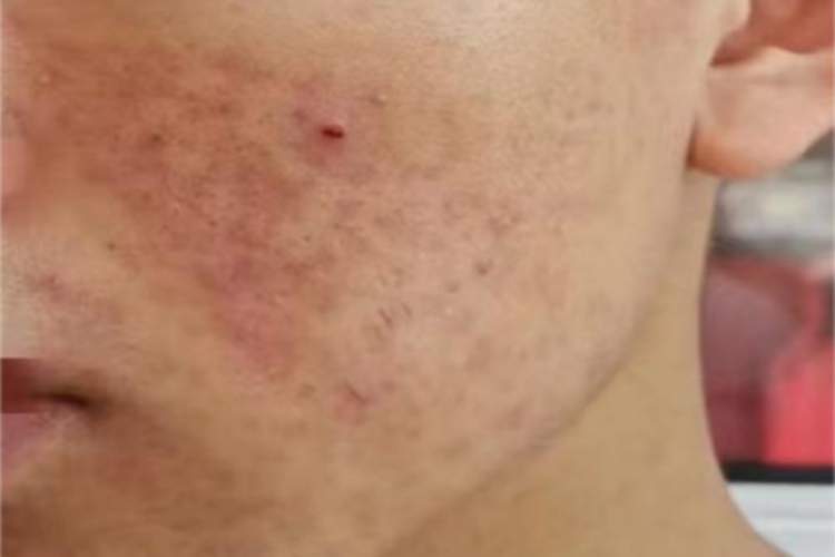 痤疮左脸有红斑皮肤粗糙图 痤疮左脸有红斑皮肤粗糙图