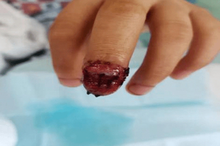 夹伤手指缺损图