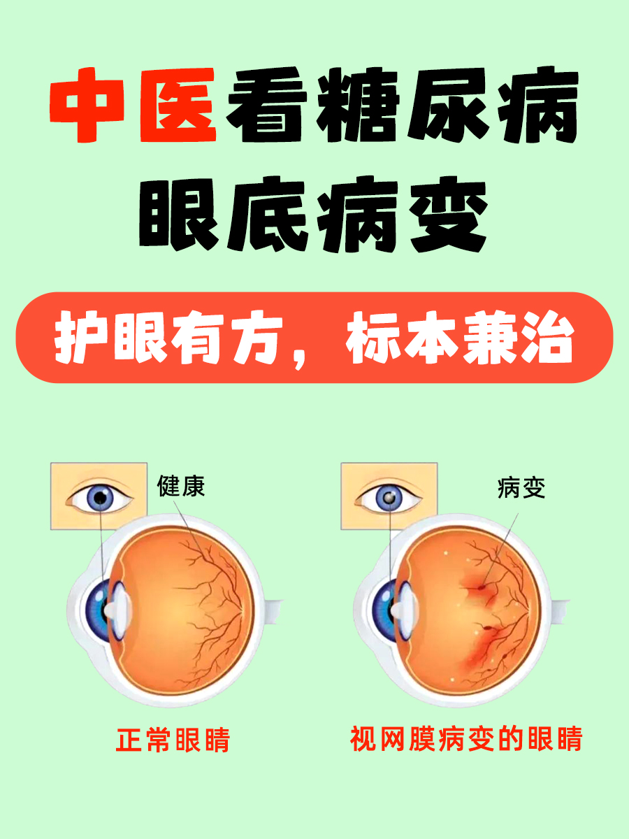 中医看糖尿病眼底病变：护眼有方，标本兼治