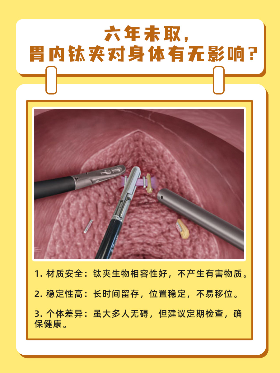 六年未取，胃内钛夹对身体有无影响？