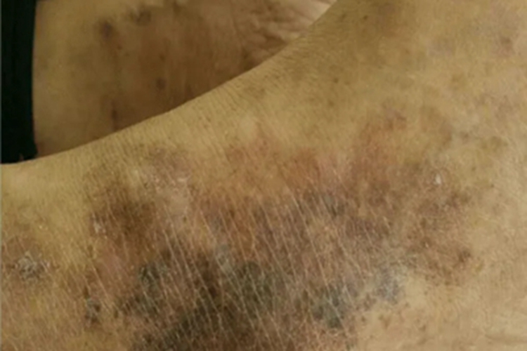 烟酸缺乏症脚踝皮肤粗糙图 烟酸缺乏症脚踝皮肤粗糙图