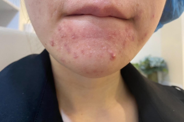 下嘴唇下边痤疮图