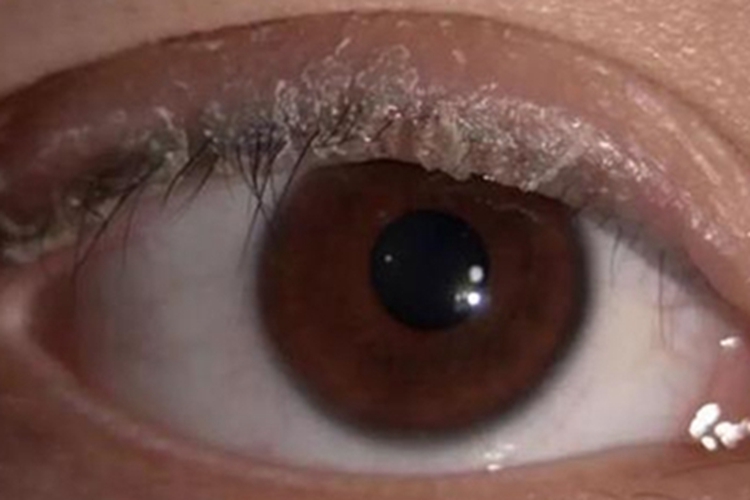 睑缘炎眼睑症状图