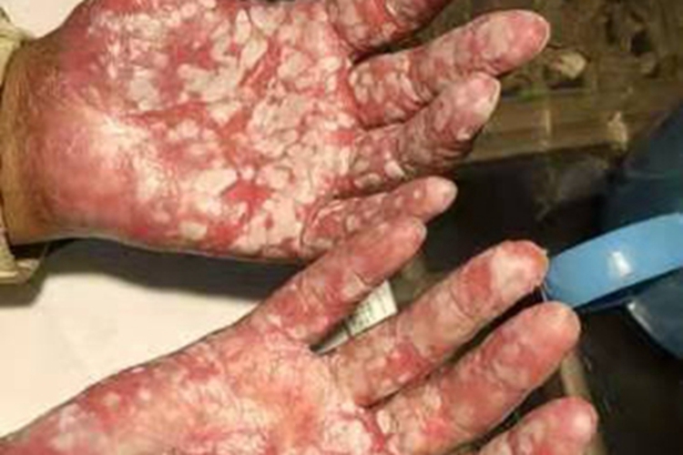手足综合征手部溃疡图