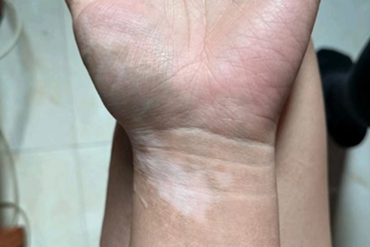 面肢端型白癜风手腕内侧有白斑图