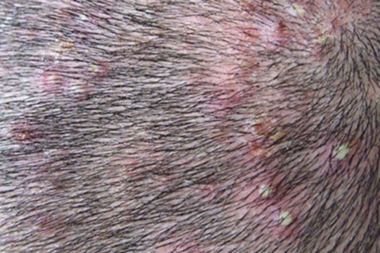 白塞病头皮上有脓包结痂图