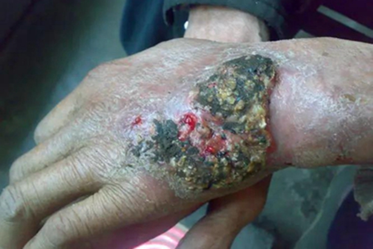 着色真菌病手背结痂图 着色真菌病手背结痂图