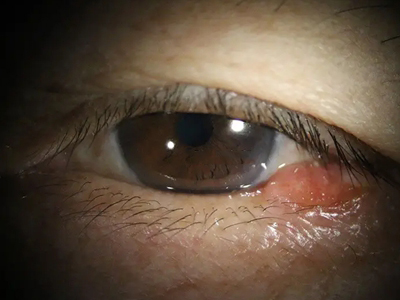 眼睑皮脂腺癌的症状和图片 