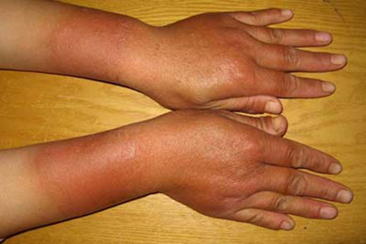 急性接触性皮炎手指症状图