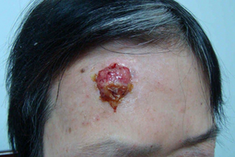 结节型基底细胞瘤前额大疙瘩图