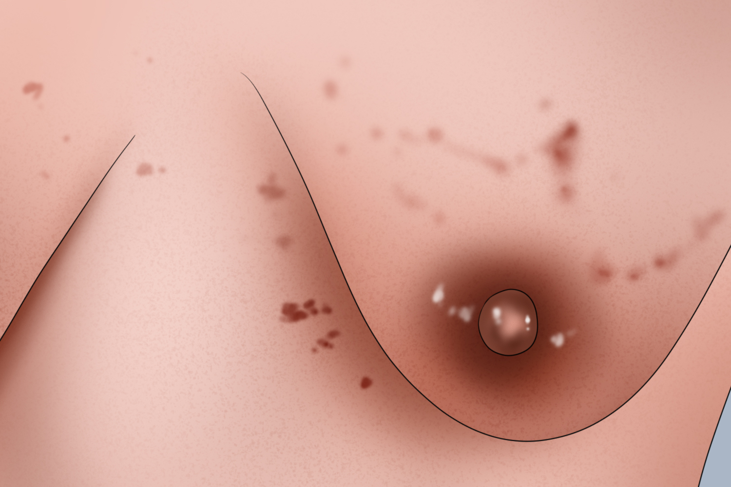 孕期身上长很多小褐色痣图片_有来医生