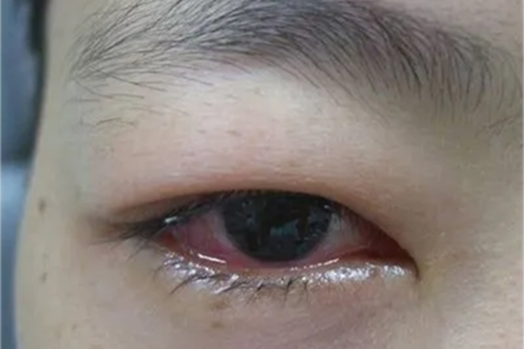 超急性细菌性结膜炎血丝图