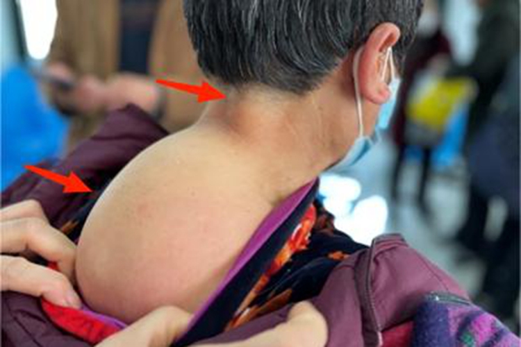 脂肪肉瘤后颈部大包图