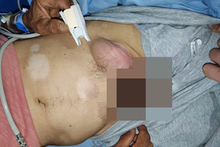 腹股沟疝大腿根有肿块图