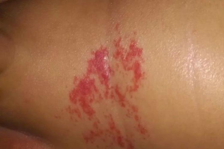 血管瘤液氮冷冻颜色变浅图