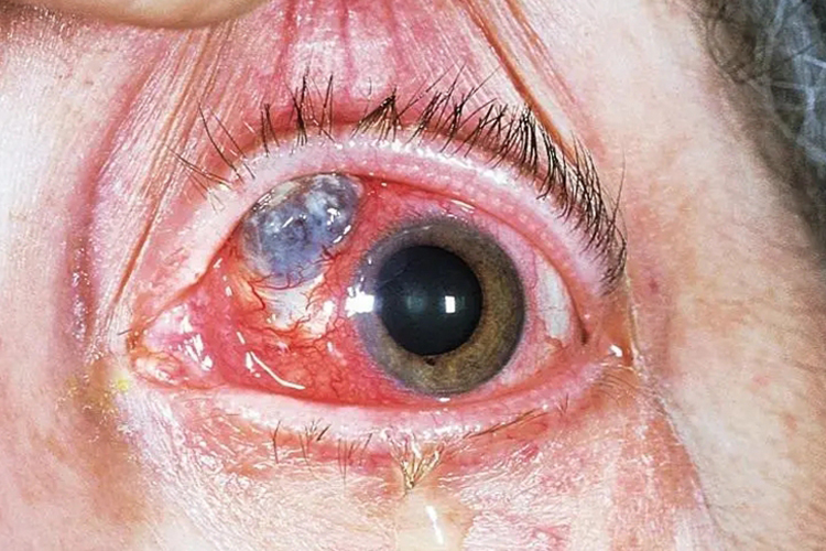 坏死性前巩膜炎图