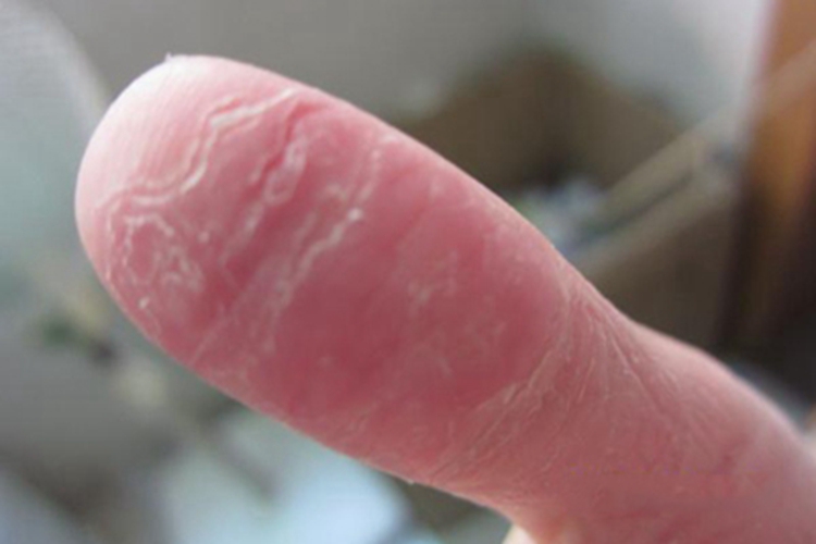 条纹状掌跖角化病症状图