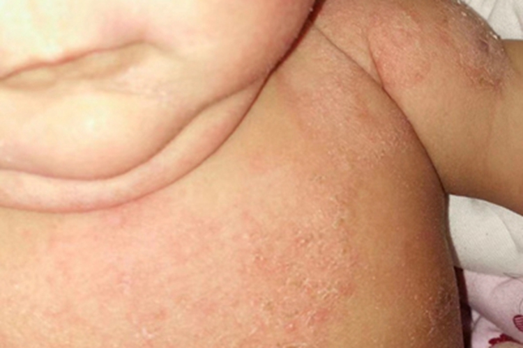 干燥型婴儿湿疹胸部脱皮图