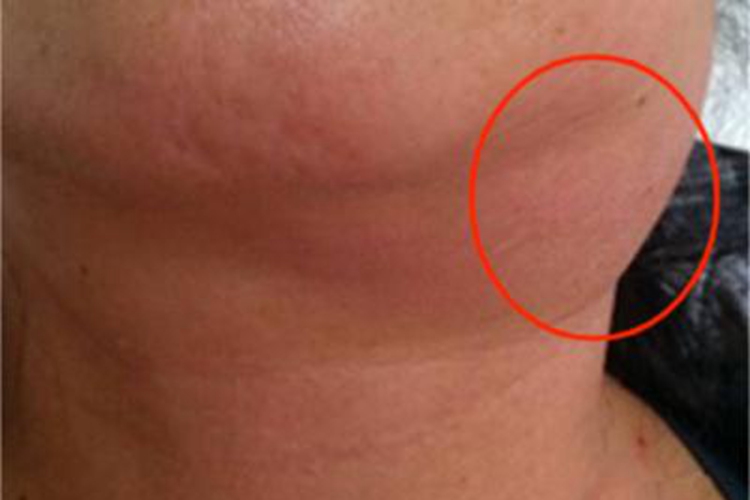 急性化脓性扁桃体炎下巴症状图 急性化脓性扁桃体炎下巴症状图