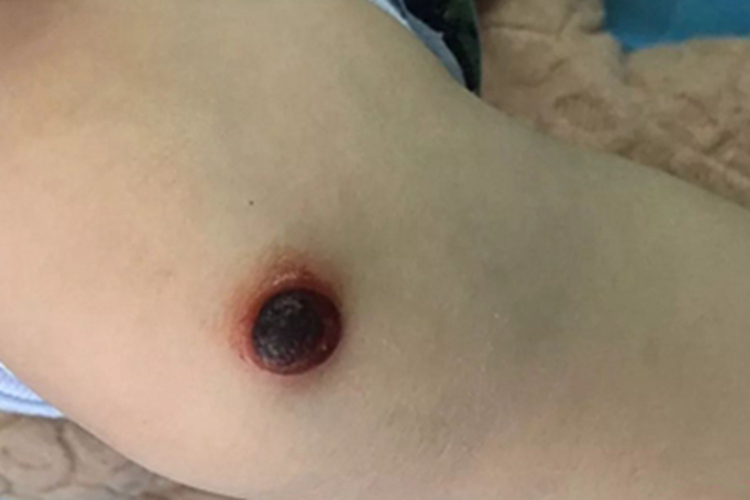 化脓性肉芽肿腿结痂图