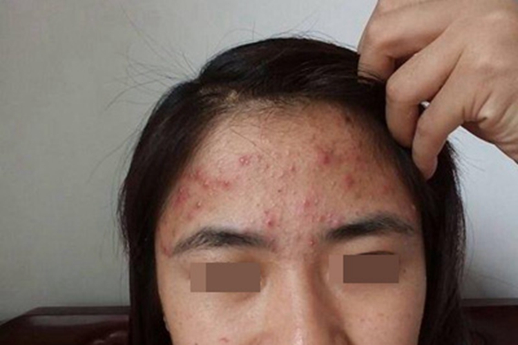 痤疮前额红色疙瘩图