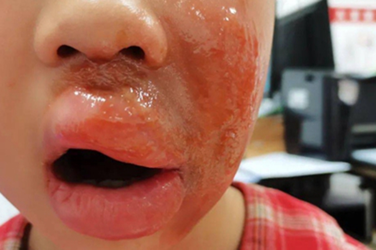 深Ⅱ度烧伤肿图