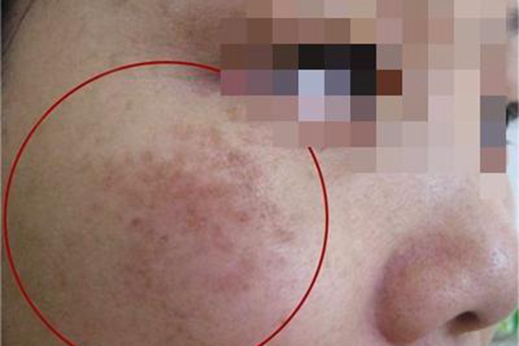 无汗症面部有红斑图