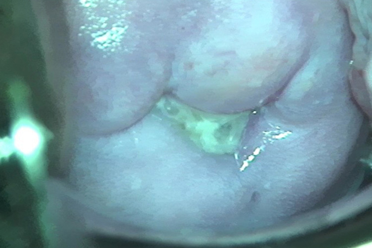 淋菌性宫颈内膜炎宫颈分泌物图