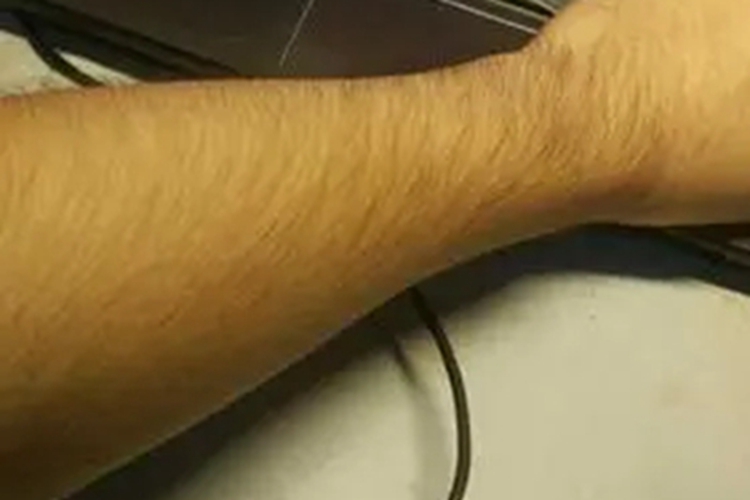 多毛症胳膊上有长汗毛图 多毛症胳膊上有长汗毛图