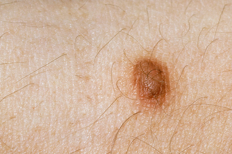 胸背部皮肤纤维瘤图