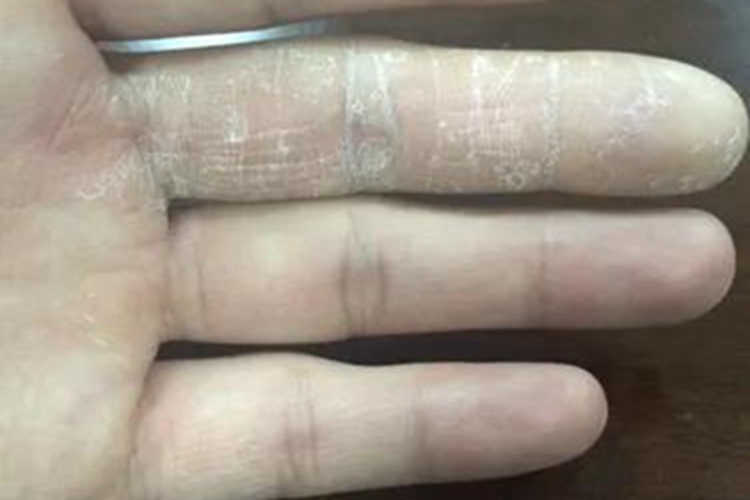 进行性指掌角皮症手指尖脱皮图 进行性指掌角皮症手指尖脱皮图