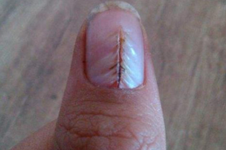 甲纵裂指甲从下面裂开图 甲纵裂指甲从下面裂开图