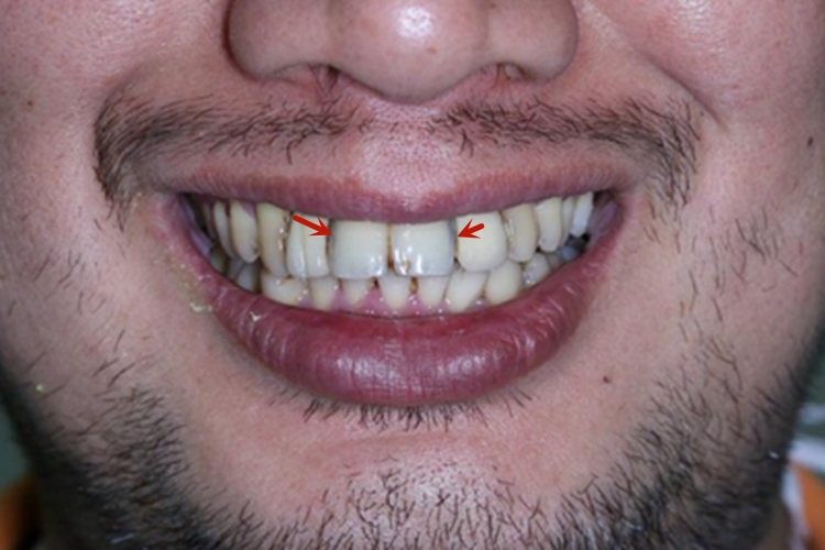 重度四环素牙牙齿发黑图