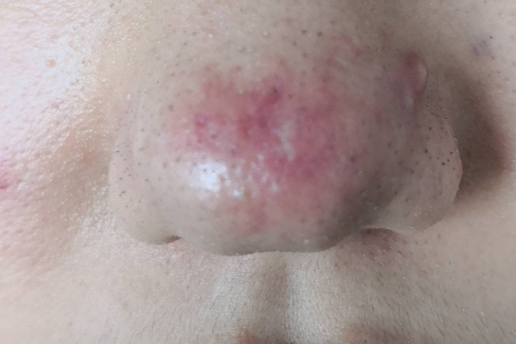 红斑毛细血管扩张型图