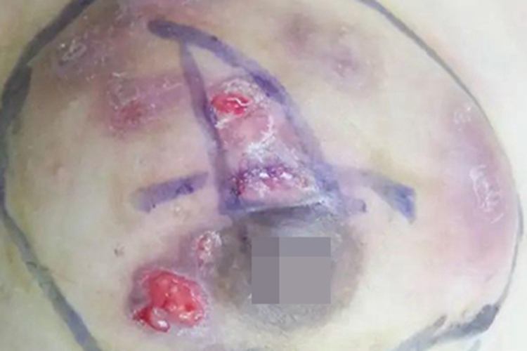 慢性乳腺炎肿块图 慢性乳腺炎肿块图