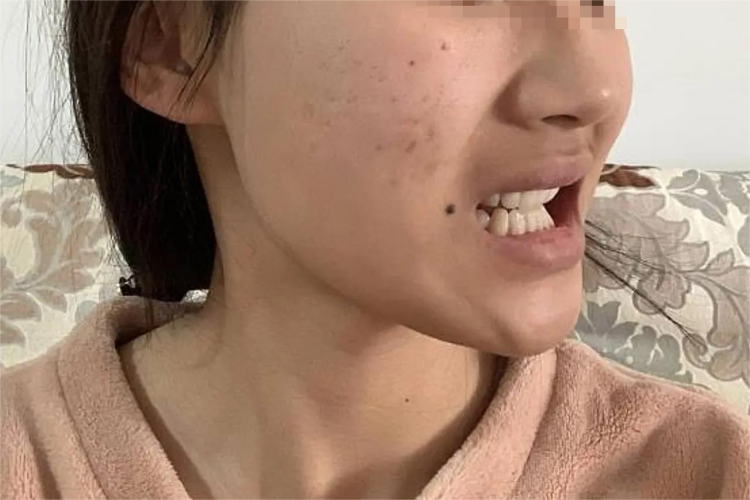 矫正牙齿内收过多嘴瘪图