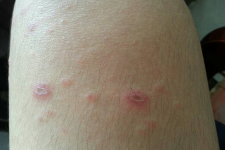 虫咬皮炎大腿结痂图 虫咬皮炎大腿结痂图