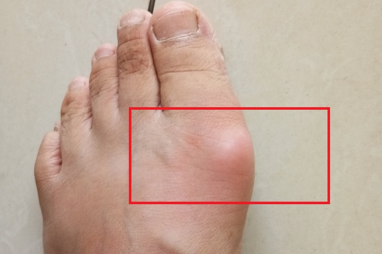 拇趾滑囊炎脚趾肿图 拇趾滑囊炎脚趾肿图
