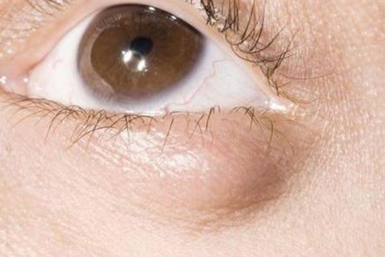 睑板腺囊肿症状图